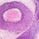 CancerSeq Paraffin Tissue Samples