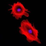 Human Primary Cancer Cells