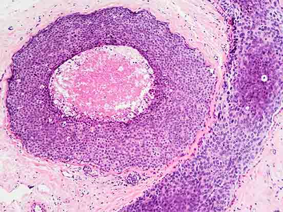 CancerSeq Paraffin Tissue Samples
